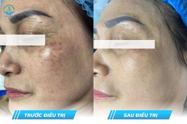 Trước & Sau