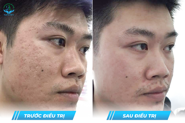 Trước & Sau