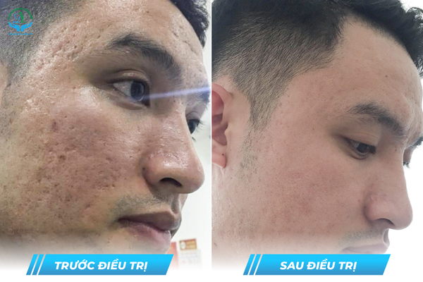 Trước & Sau
