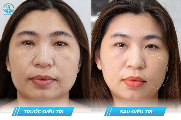 Trước & Sau