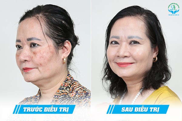 Trước & Sau