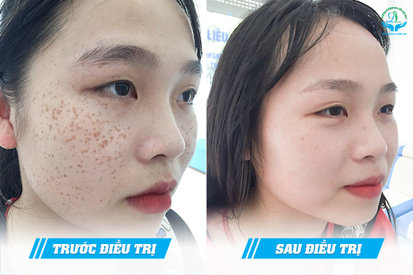 Trước & Sau