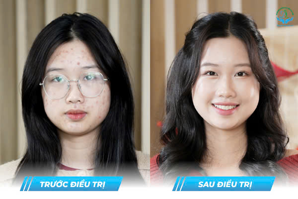 Trước & Sau