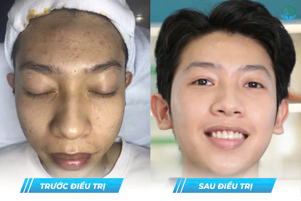 Trước & Sau
